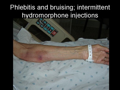 What Is Phlebitis