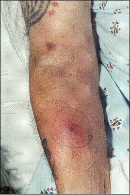 Iv Site Cellulitis